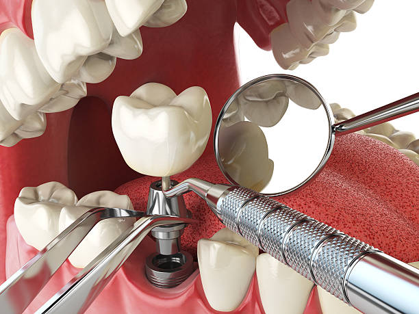 Best Emergency Root Canal Treatment in Hillsboro, MO